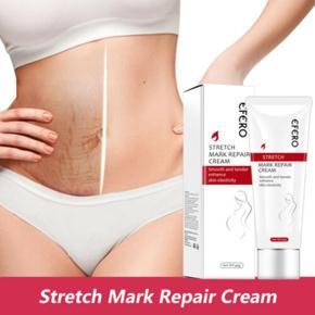 Postpartum Stretch Mark Removal Cream