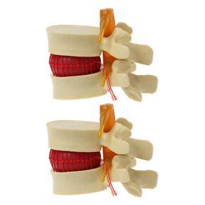 ARELENE 2X Lumbar Vertebrae Model Anatomical Spine Lumbar Disc Herniation Anatomy Teaching Tool Lumbar Vertebrae Model