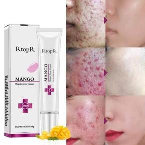RtopR Acne Cream Mango Anti-acne oil control Face cream For Women And Man